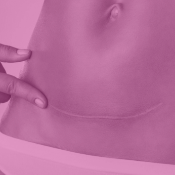 Ejercicios de pilates despues de una cesarea